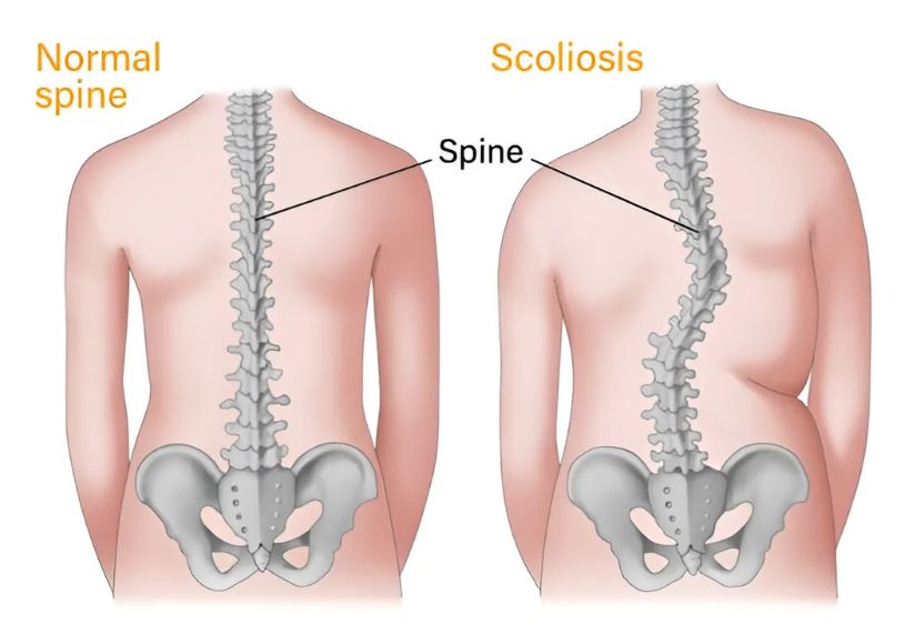 Best Spinal Deformity Surgeon for Scoliosis Surgery in Mumbai & India - Dr. Vishal Kundnani