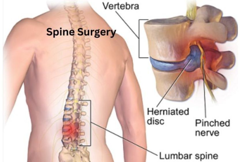 spine surgery for international patients in mumbai & india by dr. vishal kundnani